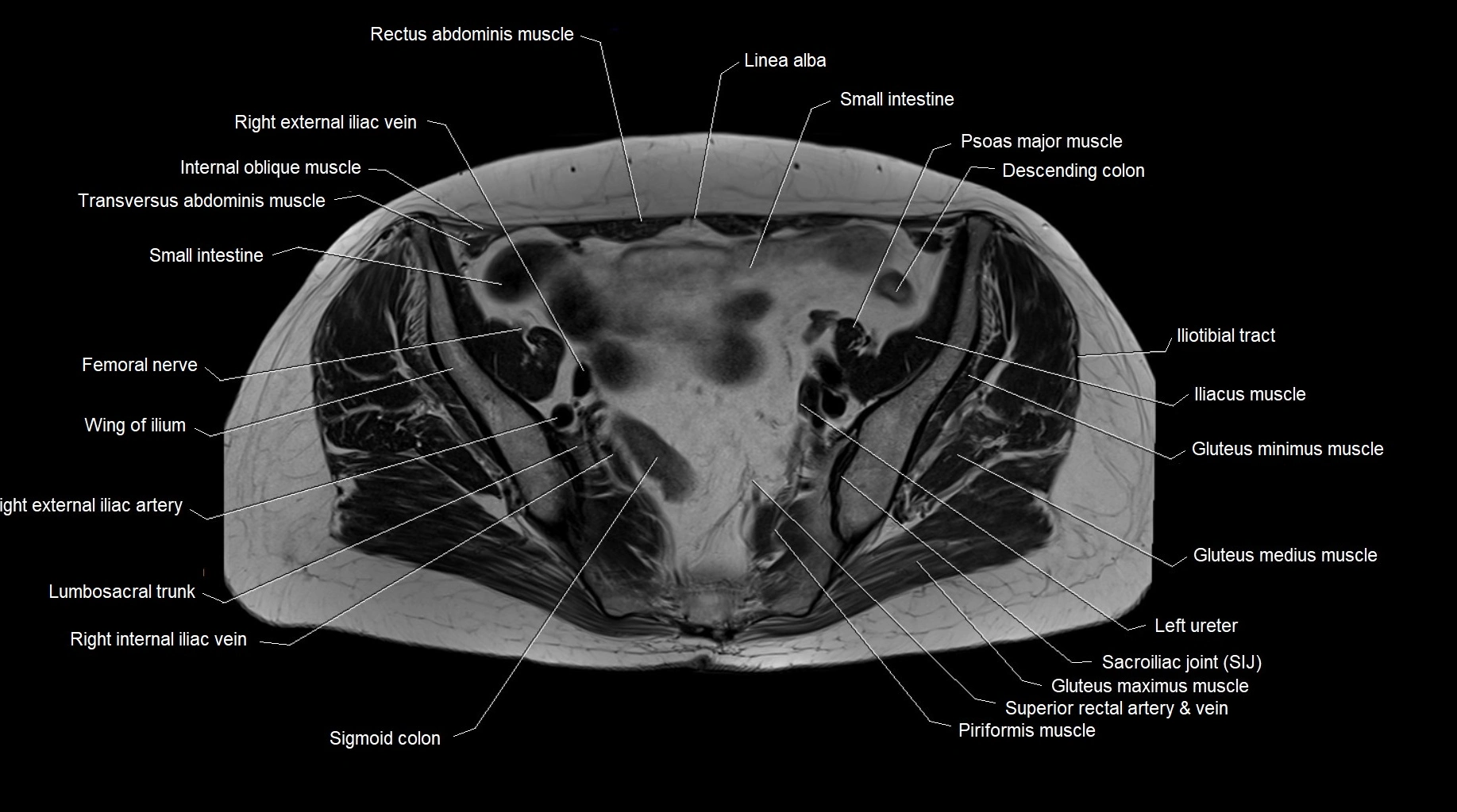 MRI 3T pelvis axial cross section anatomy image 14.webp